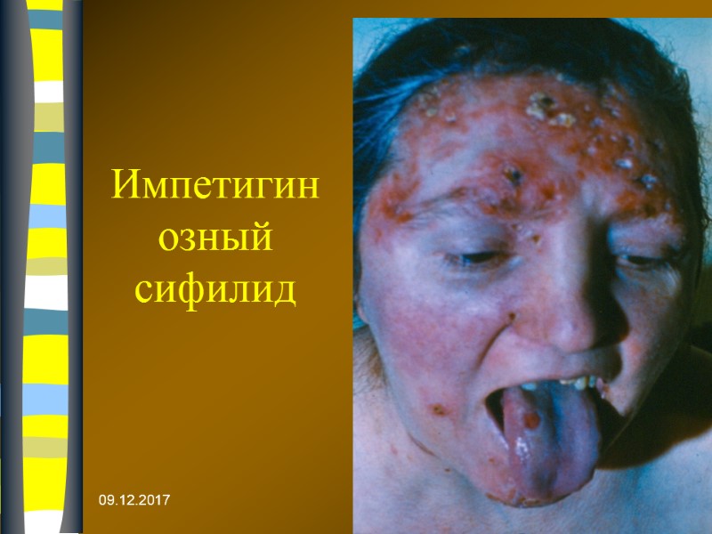 09.12.2017 Импетигинозный сифилид